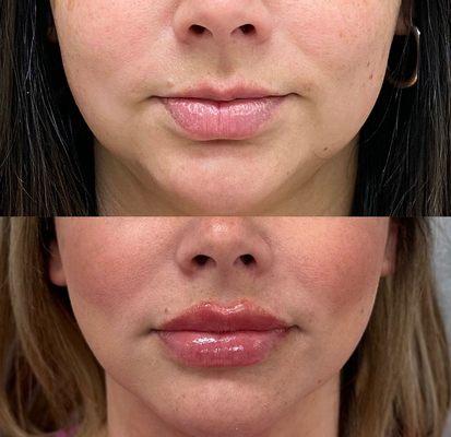 & just like that top lip and bottom lip... are LIPP'N! These don't happen overnight but definitely got the results she was looking for.