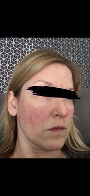 Before: Rosacea, adult acne, hives, enlarged pores, acne scars. My skin itched all the time, and burned and hurt every single day.