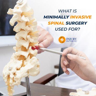 The primary focus of minimally invasive spine surgery is to relieve the pressure that may be pushing on nerves in your back