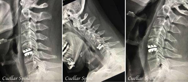 Cure chronic neck pain with total disc replacement!