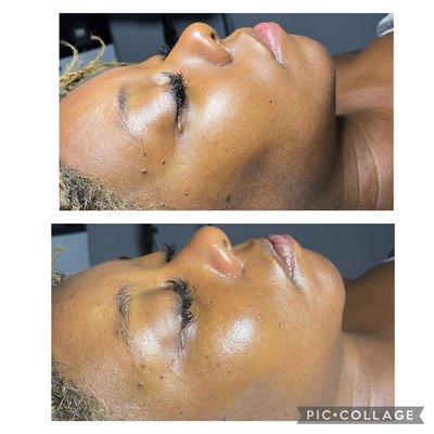 Before and after microdermabrasion and mini facial