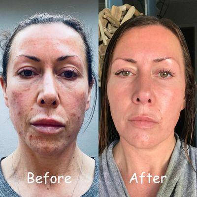 Acne and acne scars cleared after facial treatments