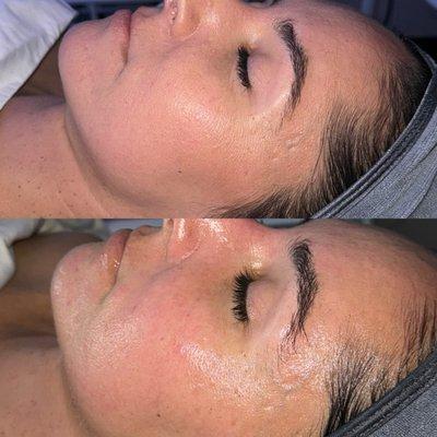 Ultimate Glow Facial Before & After