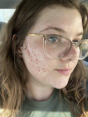 My acne just 3 months later