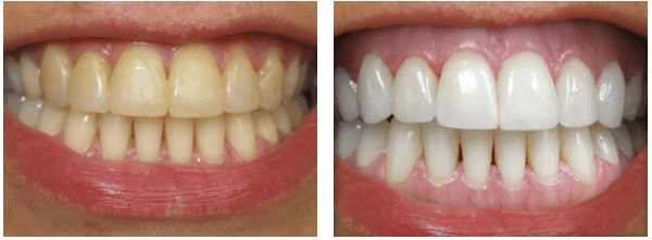 Our team achieves perfect smiles with the Boost professional whitening system.