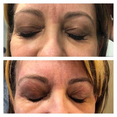 Plasma pen brow lift and non surgical upper blepharoplasty using fibroblasting technology!