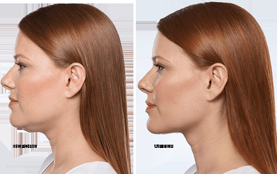 We offer Kybella injections for the reduction of the appearance of fat under the chin.