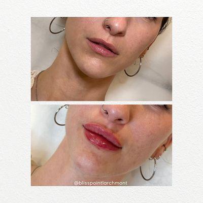 Lip Filler before & after