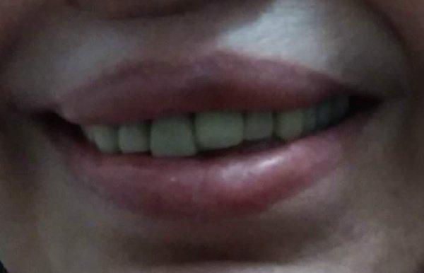 After Silvia Córdonas malpractice, I lost my gums, teeth shift, the veneers look awful, I can't really smile due the the damage.