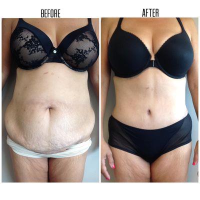 Before and After
Procedure: Tummy Tuck (Abdominoplasty)