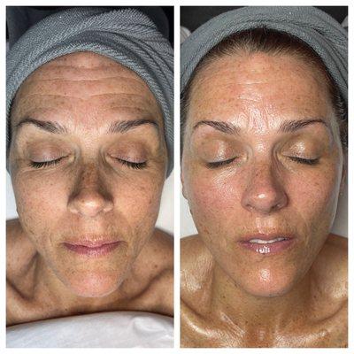 Signature Plus facial before and after.