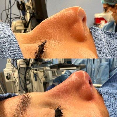 Rhinoplasty before and after #inosenoses