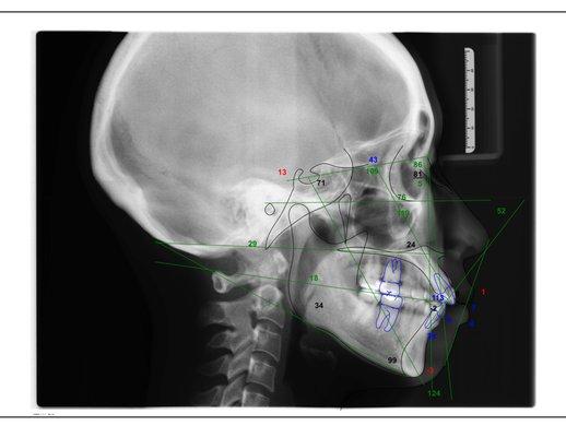 Lateral Cephalometric, tracing & analysis