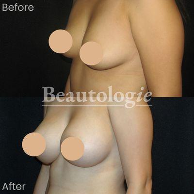 Bilateral Breast Augmentation with 400ml Saline Implants Before and After