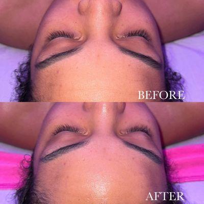 Before & After Cloud 9 Facial Treatment