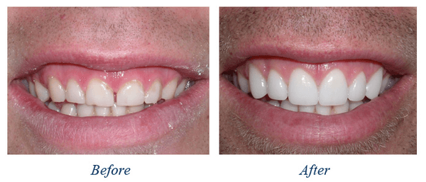 Before and After, Veneers for a cosmetic upgrade :)