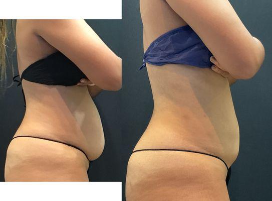 3 months after 1 treatment of CoolSculpting Elite