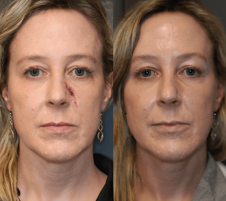 This photo highlights a successful scar reduction treatment, where the skin texture is noticeably smoother, with a reduction in the appearan