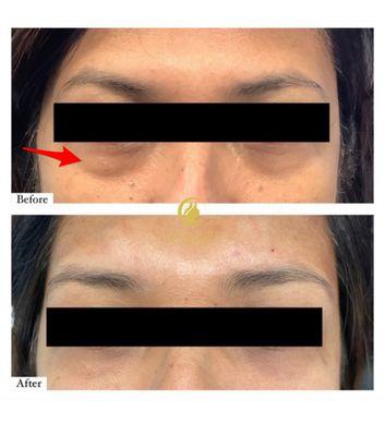 Undereye Filler before and after