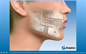 jaw surgery