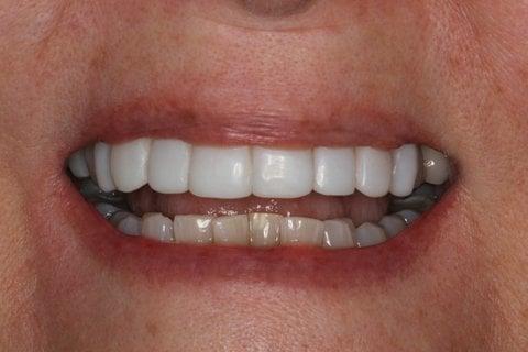 Post-op photo after EasySmile Veneer Smile Makeover, beautiful  white teeth