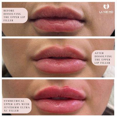 Before: Migration of filler 
During: Dissolving the old filler 
After: Injecting Juvéderm ultra XC filler for perfectly symmetrical lips