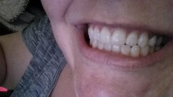 Got Pearly Whites? YES I DO!!!