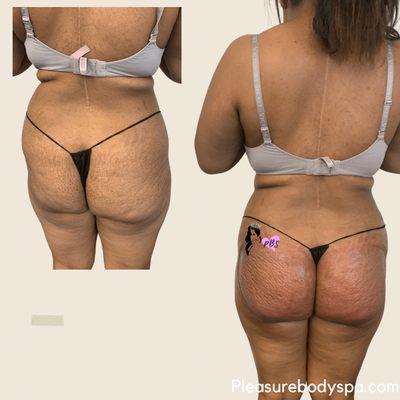 Non-Invasive ButtLift