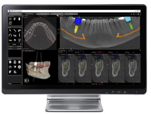 3D Diagnosis and Implant Treatment Planning  Using Carestream CBCT Technology One of the lowest radiation exposure for our patients.