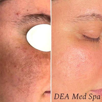 Laser Skin Resurfacing - can drastically improve the texture of your skin by improving pore size, acne scars, wrinkles and tone.