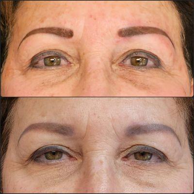 Saline Tattoo Removal to remove pigment and shrink the shape. Brows were re-done with a more complimentary shape and color.