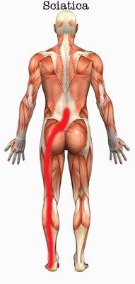 Explains sciatica and the flow of nerve pain 
Educational