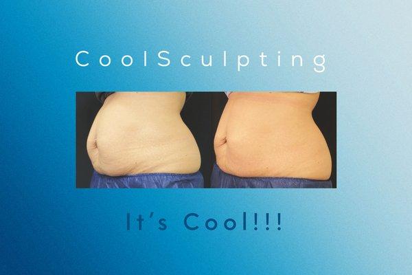 Coolsculpiting is the #1 non invasive fat reduction. The result may vary person to person.