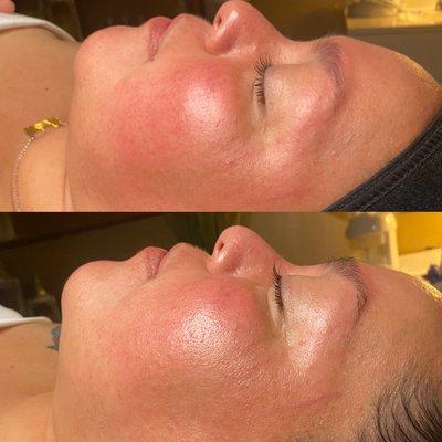 Relieved redness after Gua Sha facial