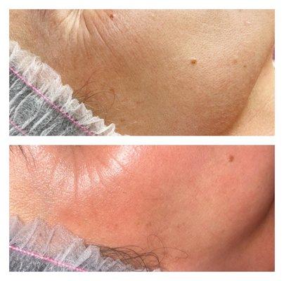 Before and after dermaplaning facial
$125