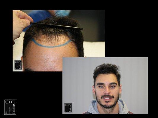 Just look at that hairline restoration for this hair transplant patient of PANINE, MD!