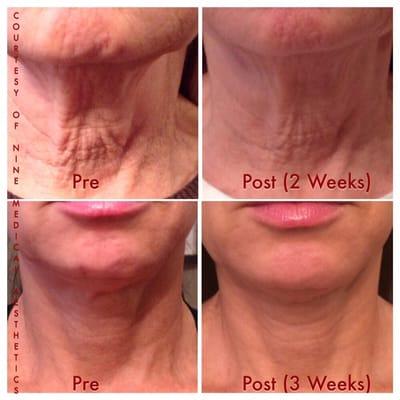 Welcoming our new Neck Cream results from our very own patients!