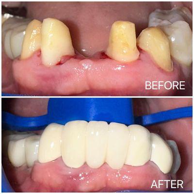 Six unit bridge transformation