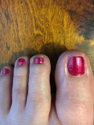 See skin around nail beds and oddly shaped nail on the great toe.