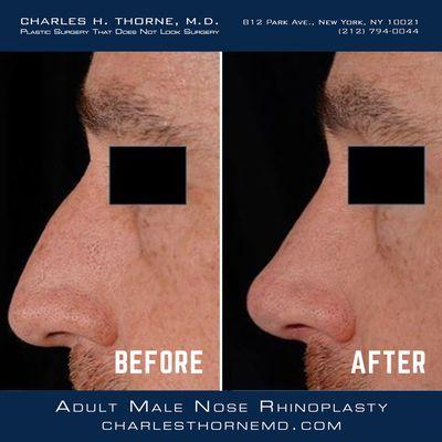 Adult Male Nose Rhinoplasty Before & After Images