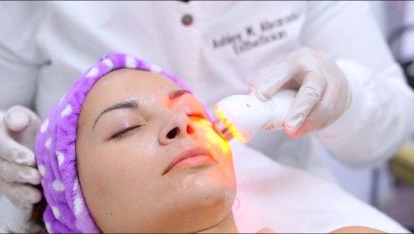 Radio Frequency Facial