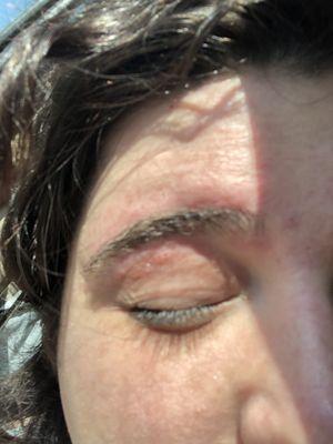 Torn skin under brow