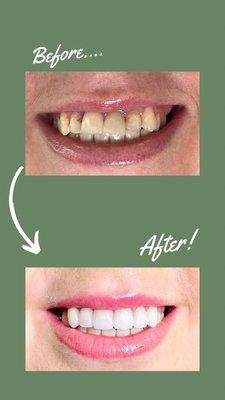 Smile makeover with porcelain veneers and crowns replacing old unaesthetic  crowns.