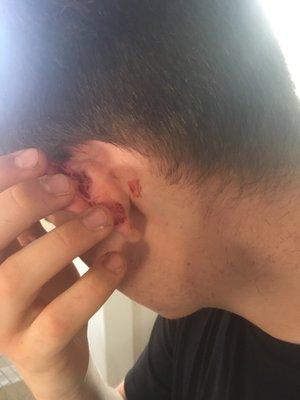 bleeding ear