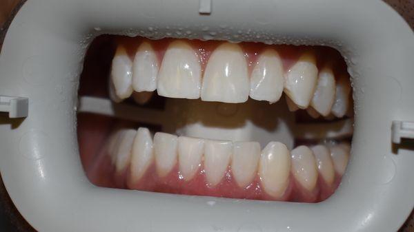 After whitening