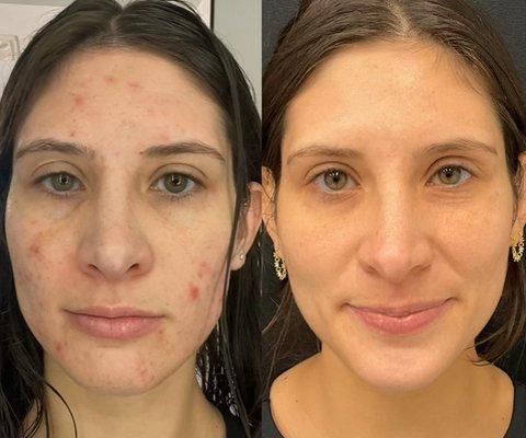 Acne Scars- Before and After