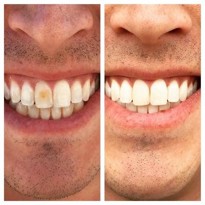 Patient had discolored from tooth. Dr. Nguyen fixed with composite and also did in office teeth whitening.