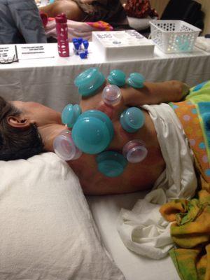 Therapeutic cupping circulatory treatment relieves pain, stiffness, lymphetic draining.