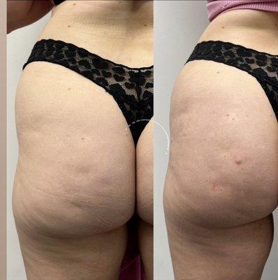 Hip dip and cellulite correction with Radiesse Biostimulant