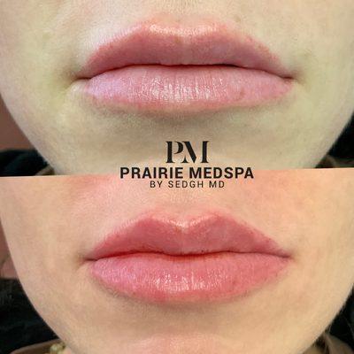 Lip enhancement at Prairie Medical Spa